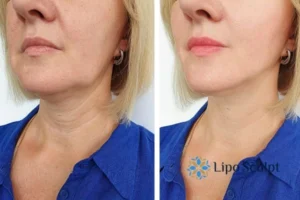 Double chin before and after Hi-Fu treatment 4 Book your double chin treatment Market Drayton today! We are here to help!