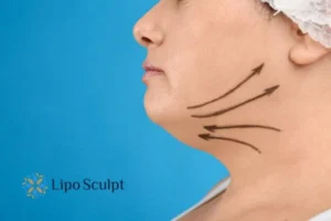 Double chin before and after Hi-Fu treatment 3 Boost your confidence with a Double chin treatment Market Drayton