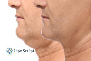 Double chin before and after Hi-Fu treatment 2 Double chin treatment Market Drayton from Lipo Sculpt - feel more confident today!