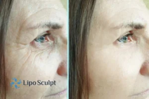 How to Fight Aging Symptoms 2 Do you want to Fight Aging Symptoms Market Drayton? Contact Lipo Sculpt today!