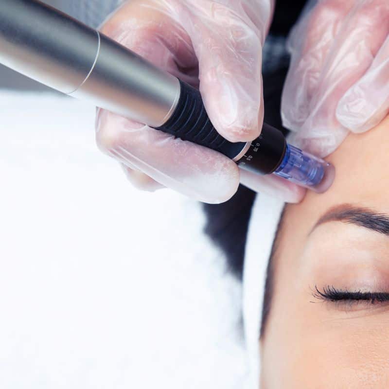 Morpheus8 treatment Market Drayton from Lipo Sculpt - Book in today!