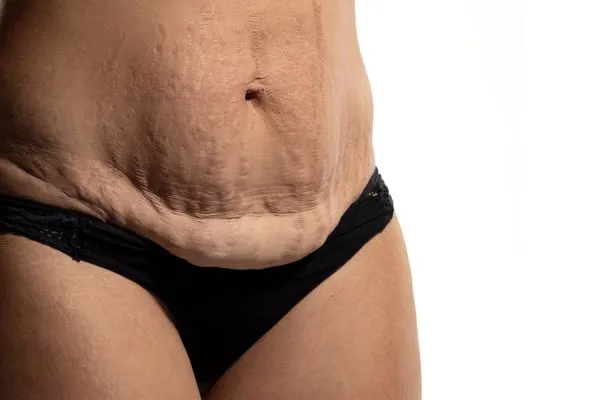 Lost the Weight but Not the Loose Skin? 1 image of womans stomach after weight loss showing loose skin Market Drayton